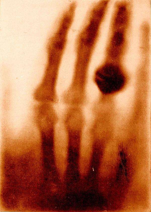 Первый рентгеновский снимок, 1895 год