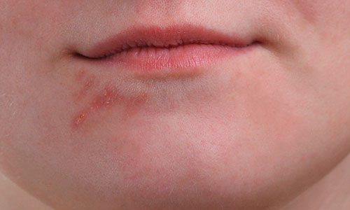 The cluster of pimples on the right has been cleaned up with the Spot Healing Brush.