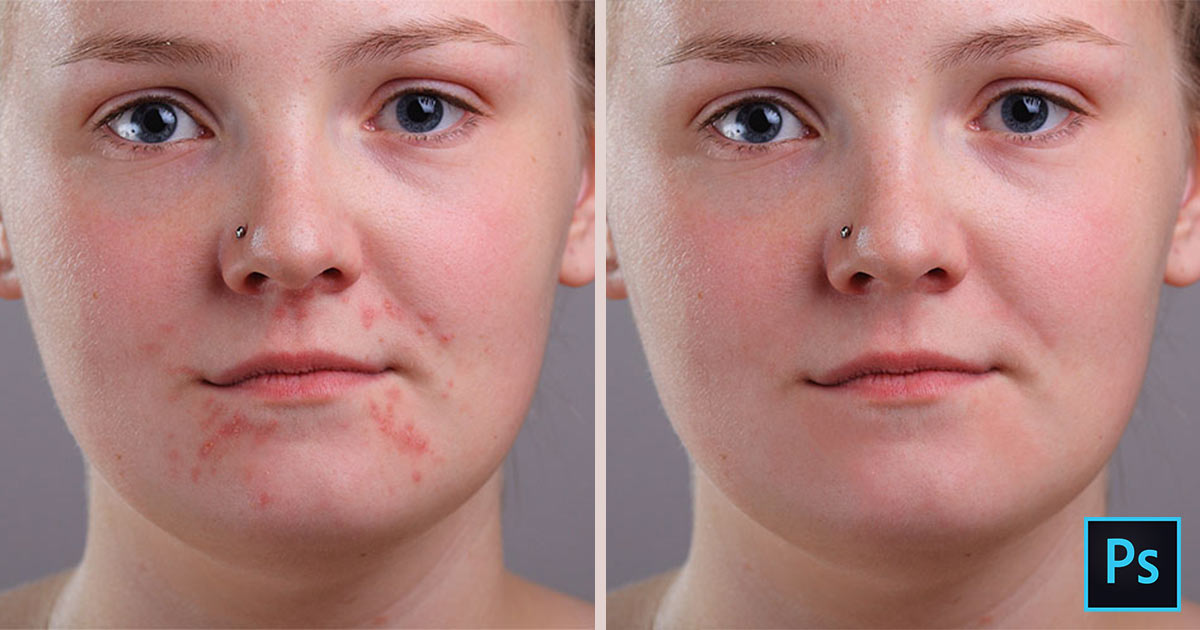How to remove acne and skin blemishes in Photoshop tutorial