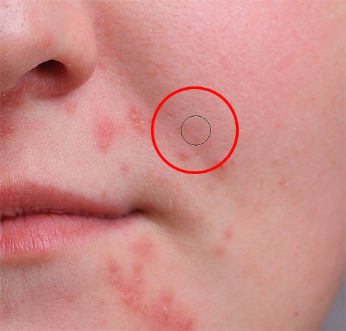 Removing a pimple with the Spot Healing Brush in Photoshop
