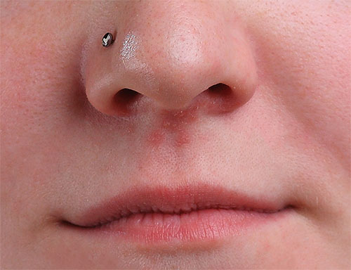 The remaining area of pimples under the girl